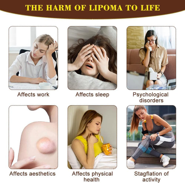 Lipoma Cream for removing lipomas and subcutaneous, suitable for all skin types