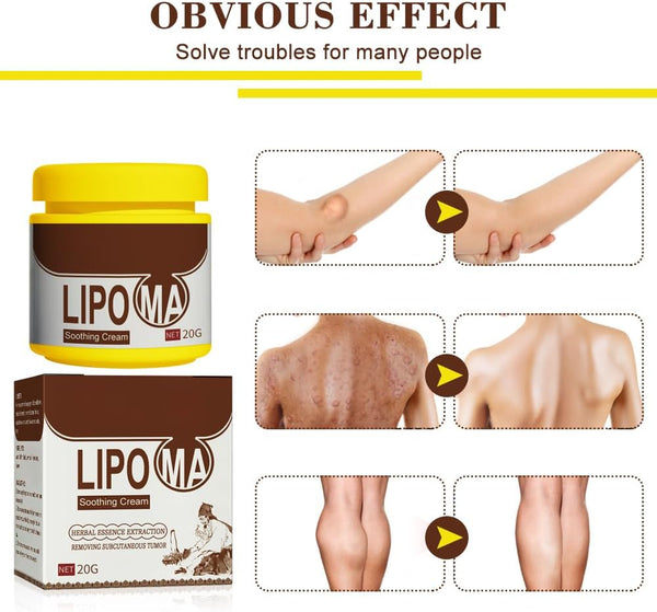 Lipoma Cream for removing lipomas and subcutaneous, suitable for all skin types